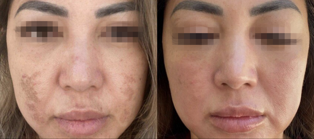 Before and after acne scar treatment results.